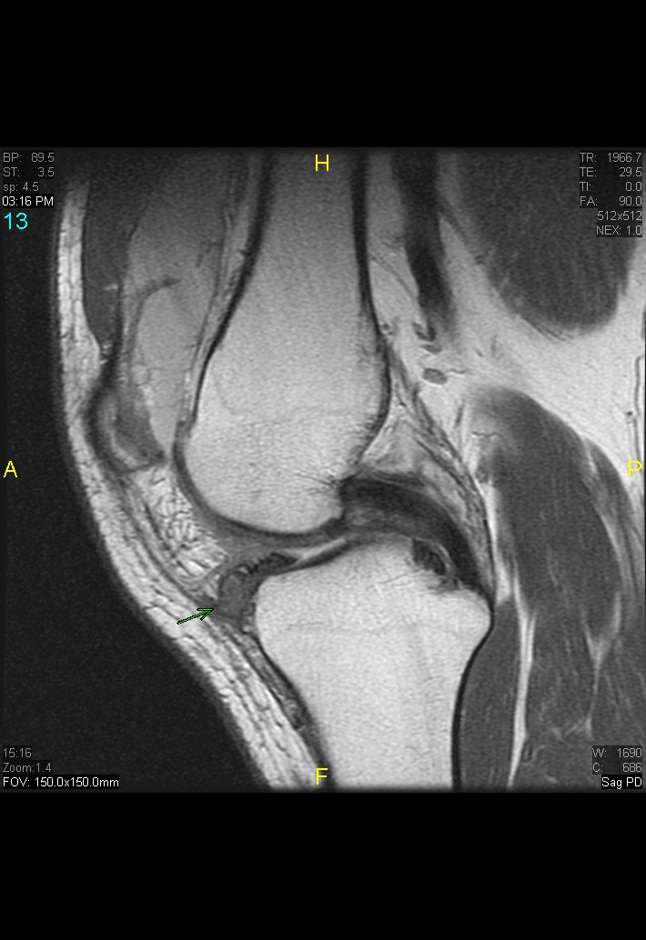 Figure 5 for case gout arthritis ( RID3567 )